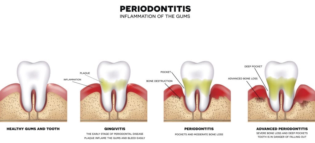 treatment for gum disease new port richey fl