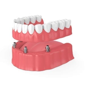 all on four implant dentures trinity fl