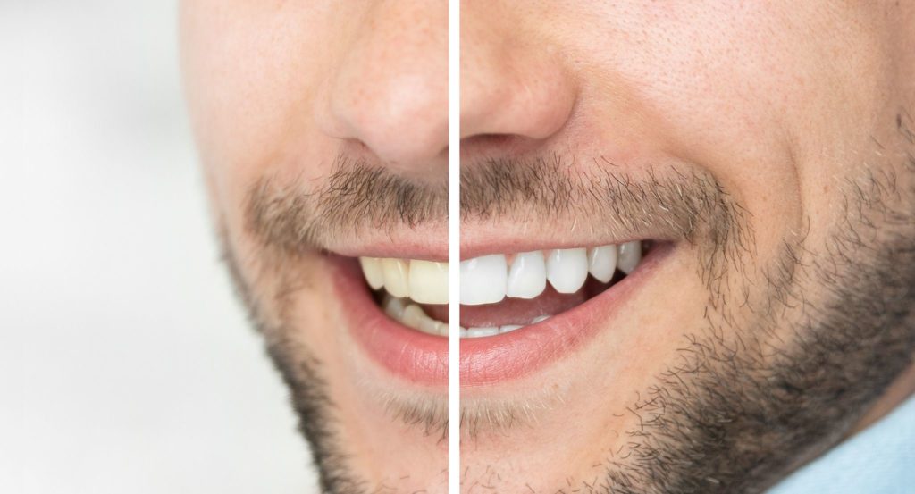 comparison of smile before and after teeth whitening dentists in Trinity Florida