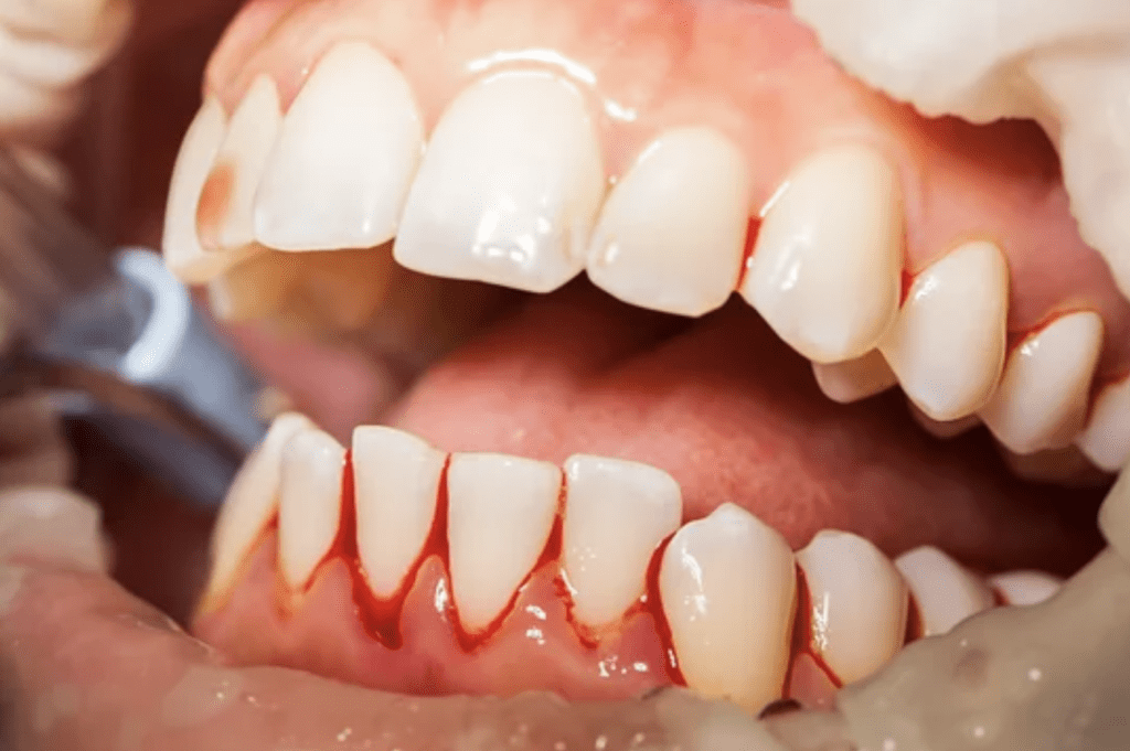 Closeup image of bleeding gums dentist in Trinity Florida