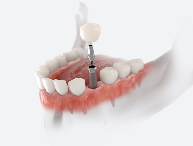 Understanding the benefits of dental implants can help you make an informed decision about your oral health and smile.