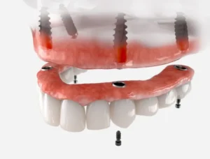 What Does FICOI Mean for Dental Implants? in Trinity, FL
